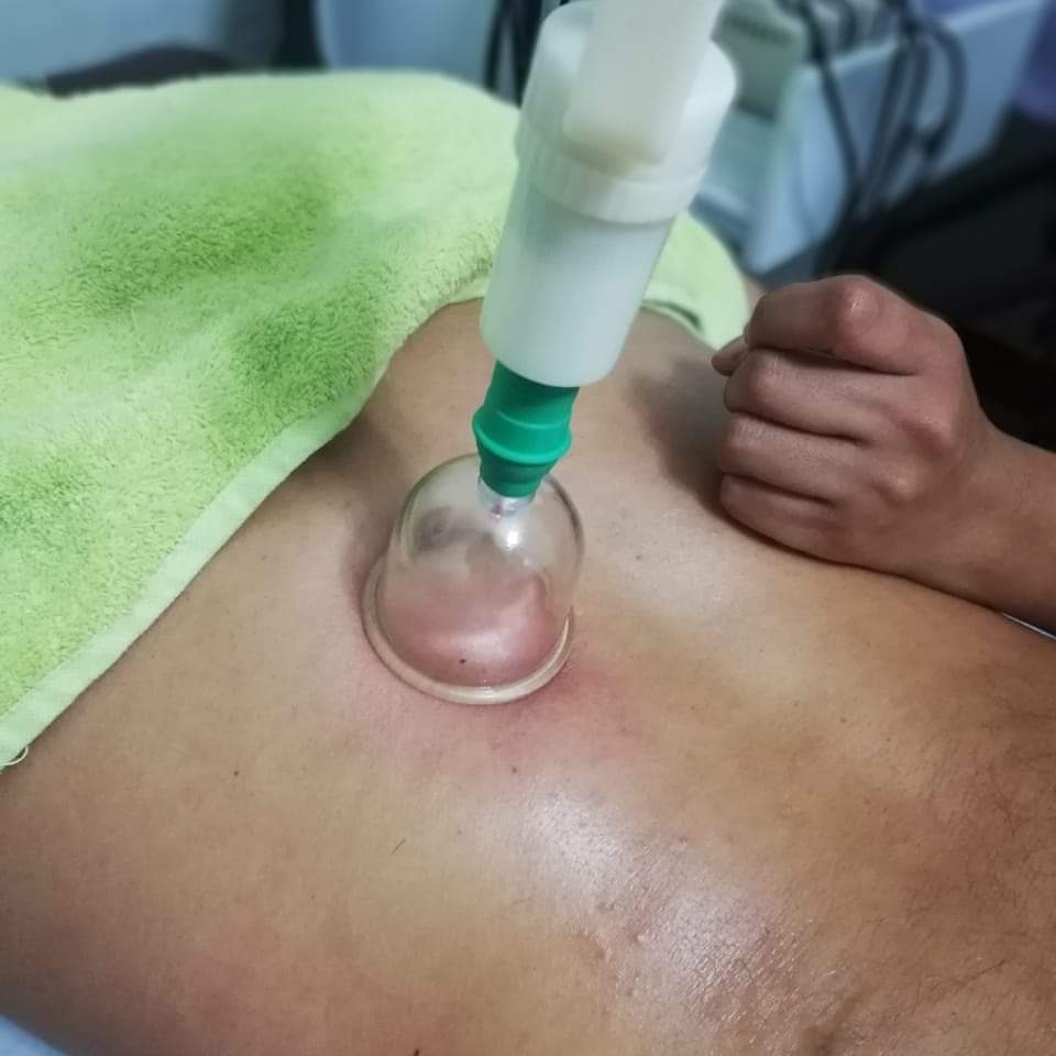 Juego de Ventosas 12 Piezas